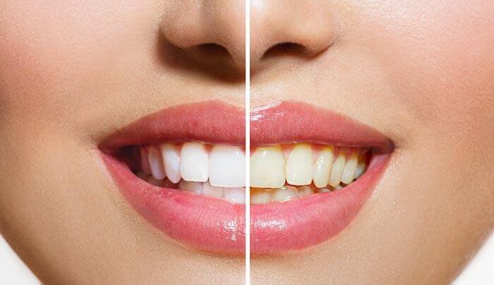 8 روش سریع برای سفید کردن دندان ها در خانه + آموزش