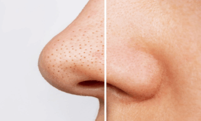 خداحافظ جوش‌ های سرسیاه بینی؛ با این روش‌ ها پوستت رو نجات بده!✨