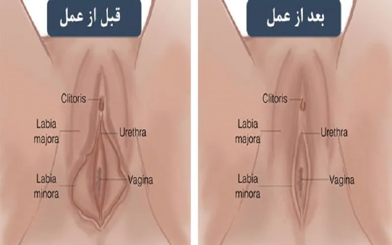 هزینه عمل زیبایی واژن چقدر است؟ - تصویر 3