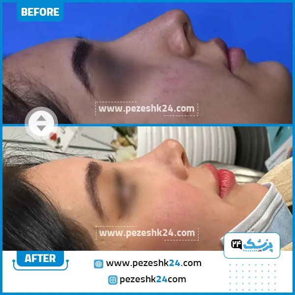 قبل و بعد عمل بینی نیمه فانتزی