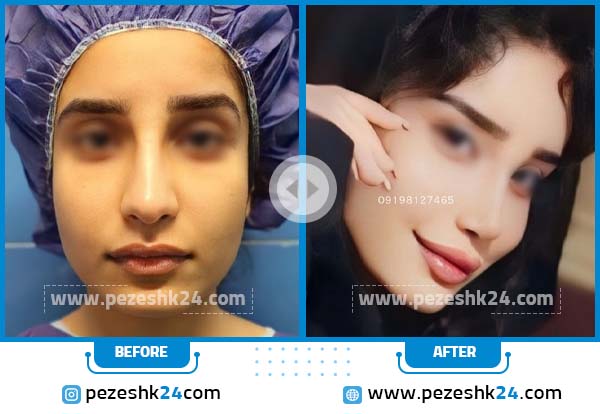 مقایسه قبل و بعد عمل بینی نیمه فانتزی