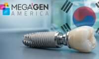 ایمپلنت مگاژن (MegaGen) | قیمت 1405، مزایا، معایب و مقایسه کامل